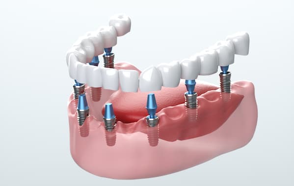 Dental implants treatment setup